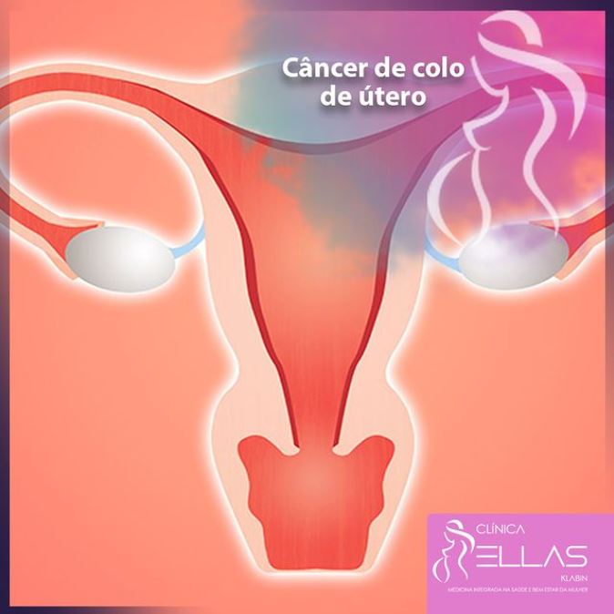 Você está visualizando atualmente Câncer de colo de útero
