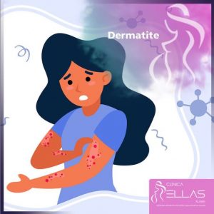 Leia mais sobre o artigo Dermatite