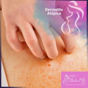 Leia mais sobre o artigo Dermatite atópica