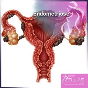 Leia mais sobre o artigo Endometriose