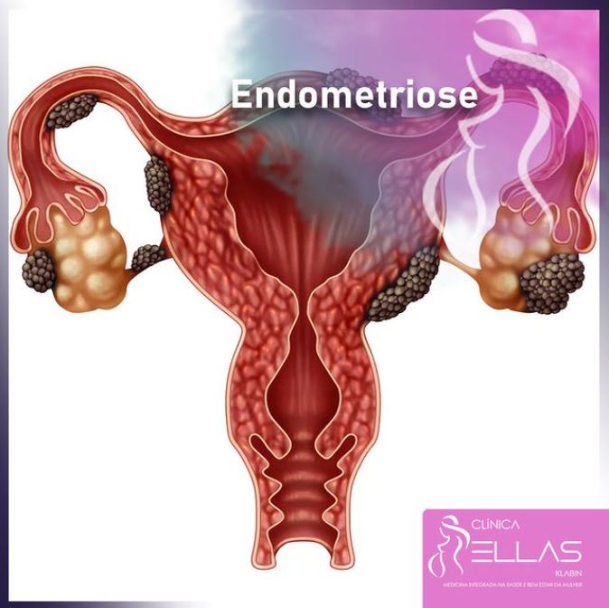 Você está visualizando atualmente Endometriose