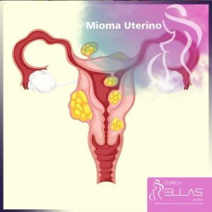 Leia mais sobre o artigo Mioma uterino